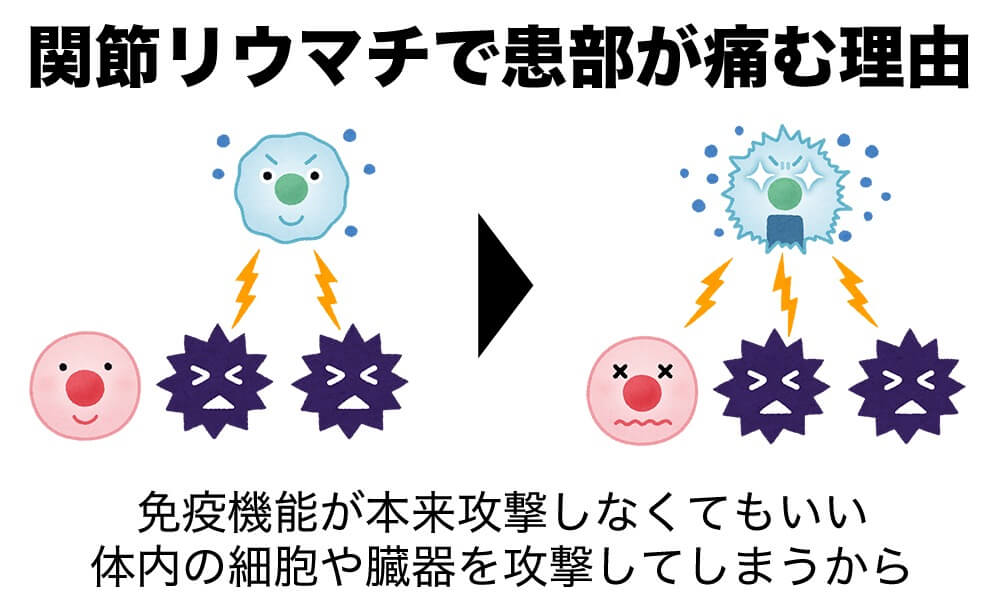 イラスト：免疫機能が偏り、自分自身を攻撃している

関節リウマチで患部が痛む理由は「免疫機能が本来攻撃しなくてもいい体内の細胞や臓器を攻撃してしまう」から