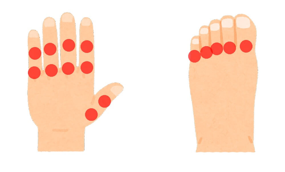 イラスト：手指の第二関節と付け根、足指の第二関節に丸がついている