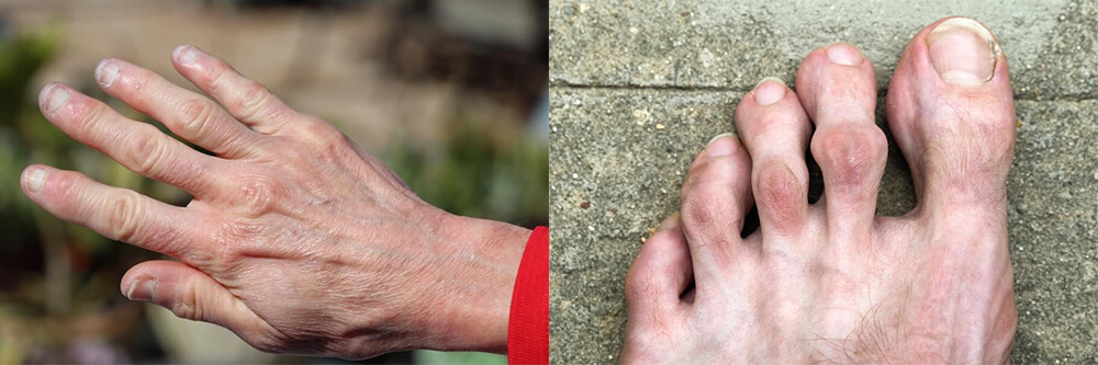 画像：関節が腫れている手と足