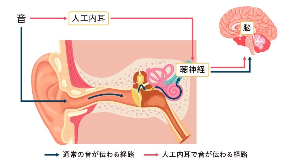 イラスト:一般的な聞こえと、人工内耳の聞こえの経路の違い
・一般的な聞こえ
音は耳から入り、聴神経を通じて脳へ届く
・人工内耳
人工内耳から聴神経へ直接届く