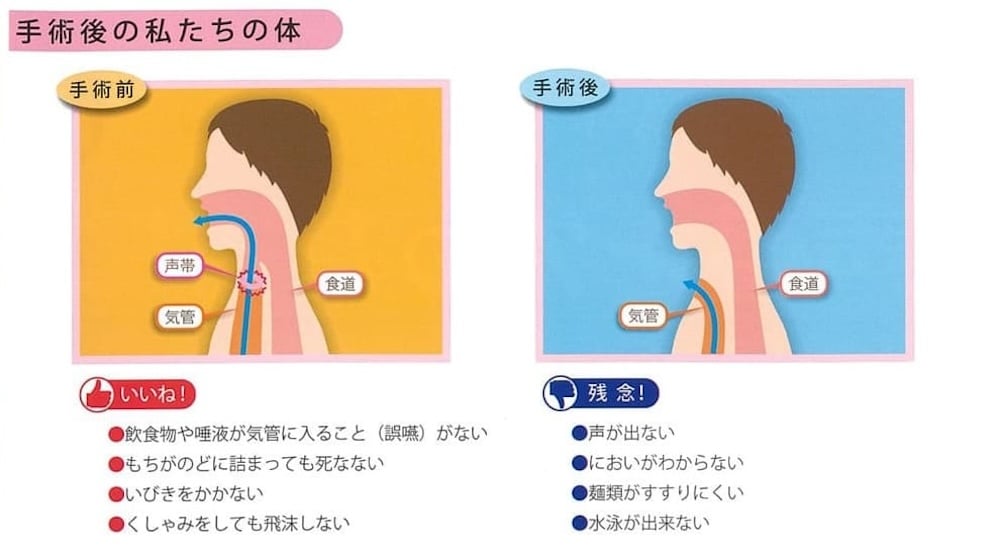 声帯摘出手術後のメリット、デメリットを示す図:
いいね!
・飲食物や唾液が気管に入ること(誤嚥)がない
・もちがのどに詰まっても死なない
・いびきをかかない
・くしゃみをしても飛沫しない
残念!
・声が出ない
・においがわからない
・麺類がすすりにくい
・水泳ができない