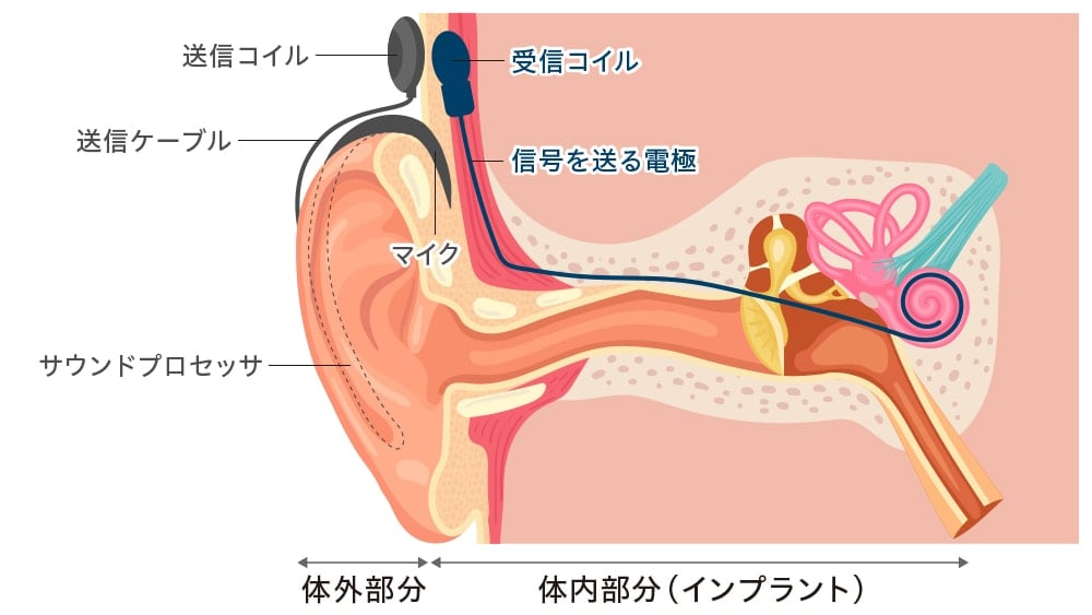 イラスト:人口内耳の仕組み
大きく分けて体外部分と体内部分(インプラント)に分かれる
・体外部分
耳に掛けたサウンドプロセッサとマイク。そこから送信ケーブルを介して、側頭部に送信コイル。
・体内部分(インプラント)
側頭部の内部に受信コイルがあり、そこから蝸牛に向かって電極が伸びている
