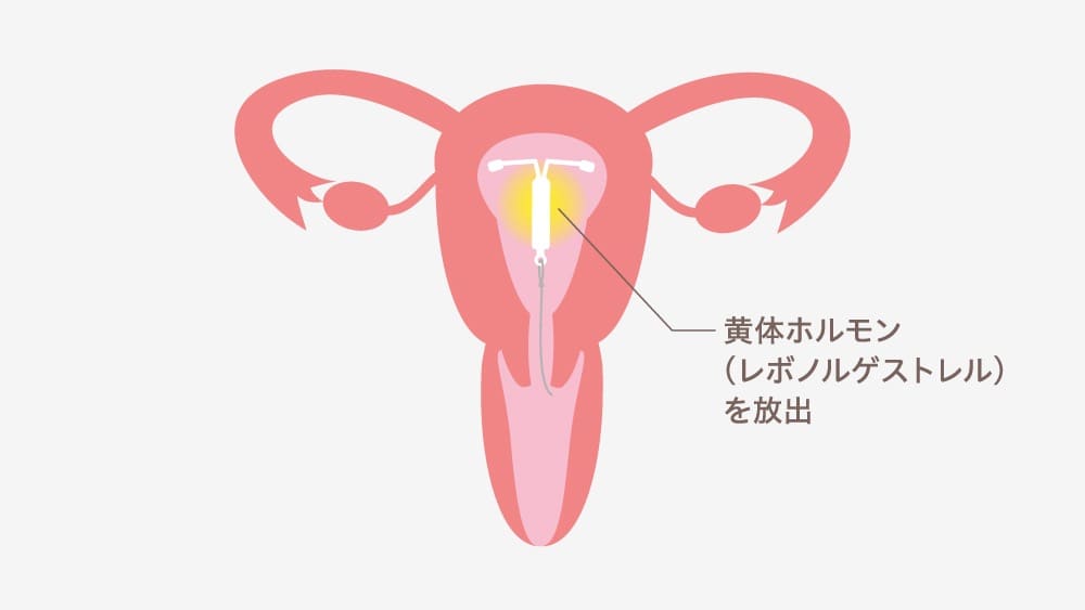 イラスト:子宮に装着したミレーナから黄体ホルモンが放出されている