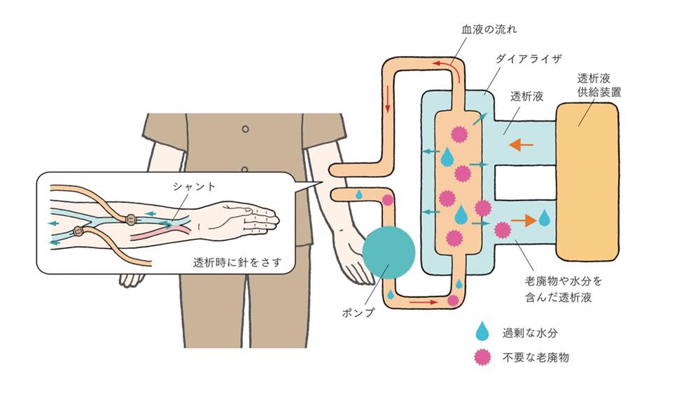 血液透析の仕組みを説明するイラスト。患者の腕にあるシャントに透析用の針が刺され、血液がポンプによって体外に取り出される。血液はダイアライザ(人工腎臓)を通り、透析液供給装置から送られてくる透析液と接触することで、血液中の不要な老廃物や過剰な水分(ピンク色と青色のマーク)が透析液に移動する。浄化された血液は再び体内に戻される。
