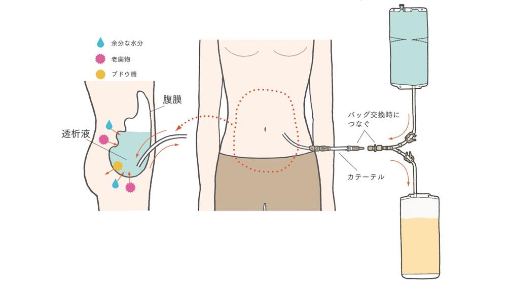 腹膜透析の仕組みを示すイラスト。患者の腹部にカテーテルが挿入されており、透析液が体内の腹膜腔に注入される。透析液は腹膜を介して血液中の老廃物や余分な水分(ピンク色と青色のマーク)を吸収し、ブドウ糖(黄色)も含まれている。一定時間経過後、使用済みの透析液は排出され、新しい透析液と交換される。透析液の出入りはバッグとカテーテルを通じて行われる。